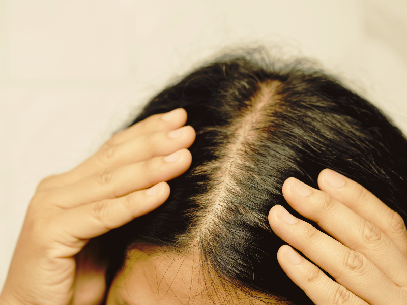 L&rsquo;alopécie Androgénétique